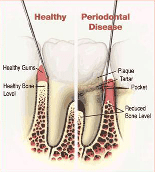 Gum Disease Dentures Alaska